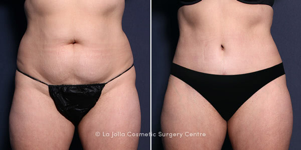 plastic surgery before and after