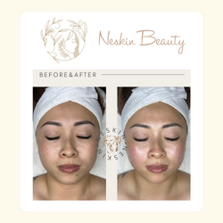 before and after facial